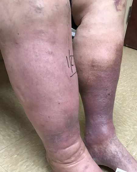 Leg Swelling Treatment