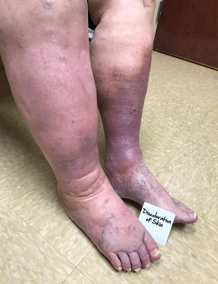 Lower Leg Discoloration: What Does It Mean?