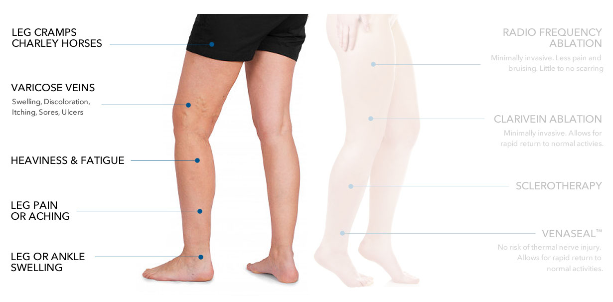 Leg Pain Symptoms