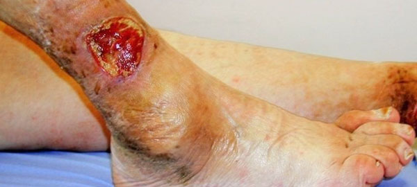 Leg Ulcers