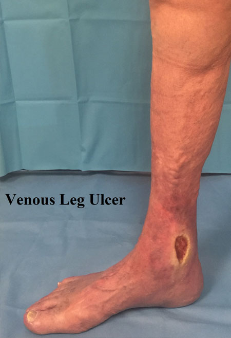 Venous Leg Ulcers