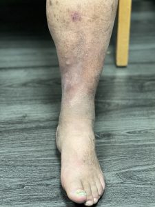 Alpha_Vein_Clinic_After_Venous_Disease_Treatment_Leg_Ulcer_Las_Vegas_Dr._Sassan_Kaveh