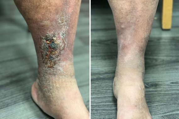 Alpha_Vein_Clinic_Before_and_After_Venous_Disease_Treatment_Las Vegas_Dr._Sassan_Kaveh