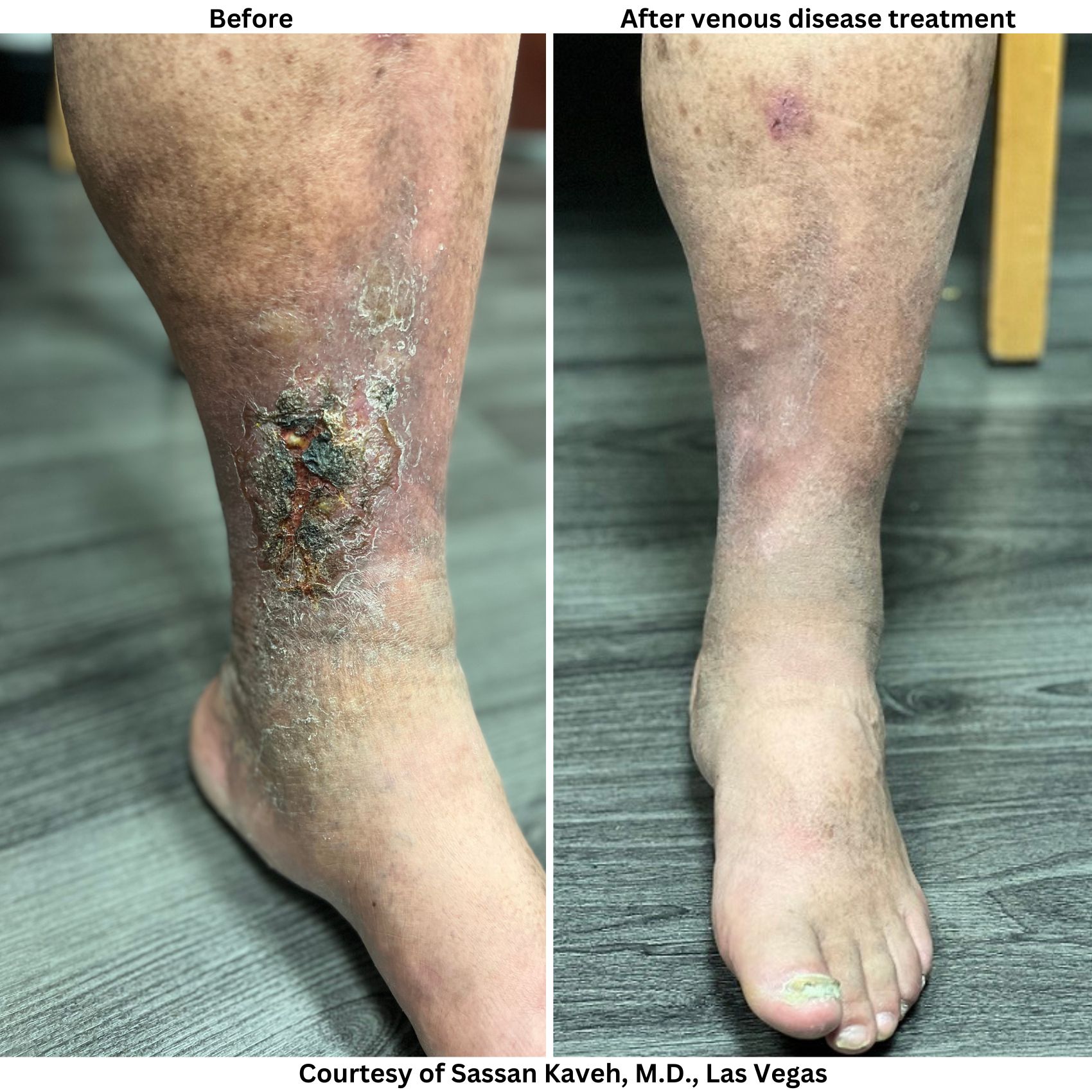 Alpha_Vein_Clinic_Before_and_After_Venous_Disease_Treatment_Las Vegas_Dr._Sassan_Kaveh