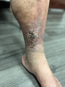 Alpha_Vein_Clinic_Before_Venous_Disease_Treatment_Leg_Ulcer_Las_Vegas_Dr._Sassan_Kaveh