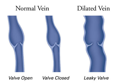 Alpha_Vein_Clinic_Normal-Vein-vs.-Dilated-Vein_Treatment_Dr._Sassan_Kaveh